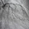 Revisión contemporánea de la Disección Espontánea de Arterias Coronarias: Hallazgos angiográficos y diagnósticos dife-renciales