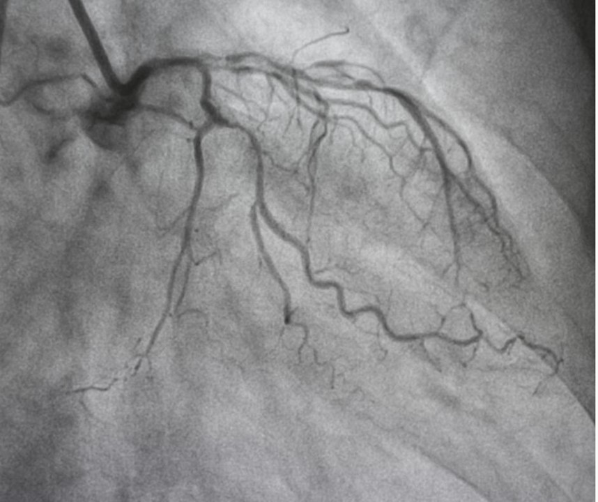 Revisión contemporánea de la Disección Espontánea de Arterias Coronarias: Hallazgos angiográficos y diagnósticos dife-renciales